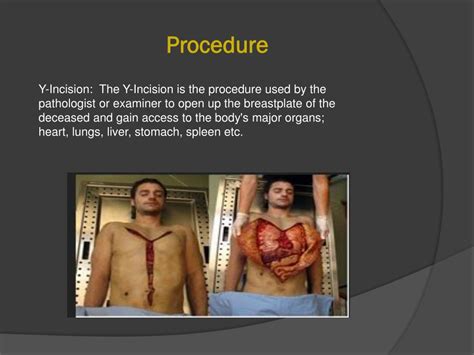 Autopsy: Definition, Purpose, Procedure, Results & Types .